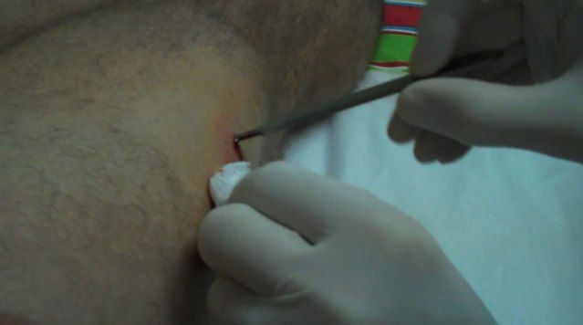 injection in leg